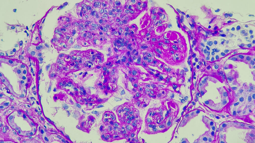 CAR-T terapija u autoimunitetu: pet godina iznenađujućih rezultata